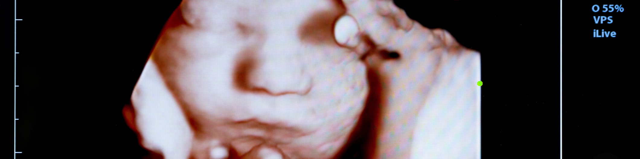  Baby-Ultraschall.jpg